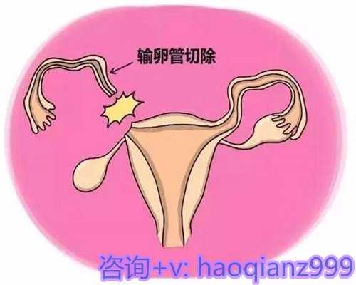试管婴儿费用构成与术后保健指南